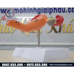 Mô hình bệnh lý Tử cung